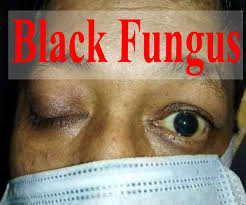 AIIMS Bathinda constituted task force to tackle Mucormycosis (Black Fungus)-Photo courtesy-Internet