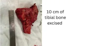 Rare ortho surgery done by Dr Amandeep Bakshi at Rajindra Hospital; patient saved from advised amputation